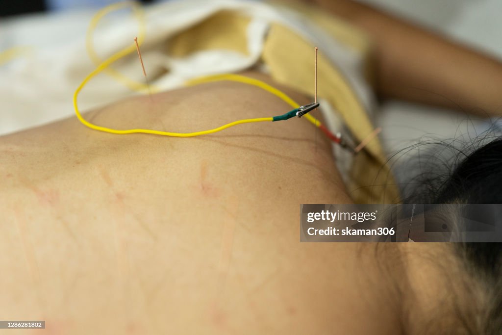 Close up hand of Chinese female doctor prepare needle for acupuncture treatment and chinese traditional therapy