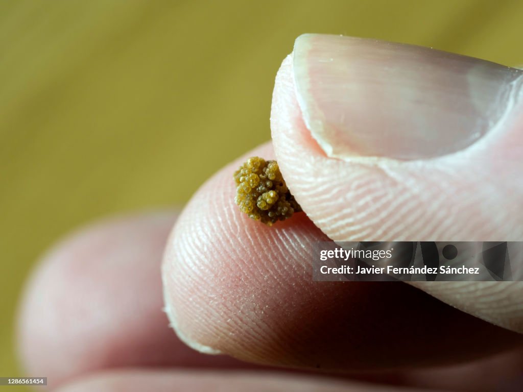 A calcium oxalate kidney stone to see its actual size between your toes. This size can be expelled by a patient, but a little larger can cause colic to the kidney by getting stuck in the ureter.