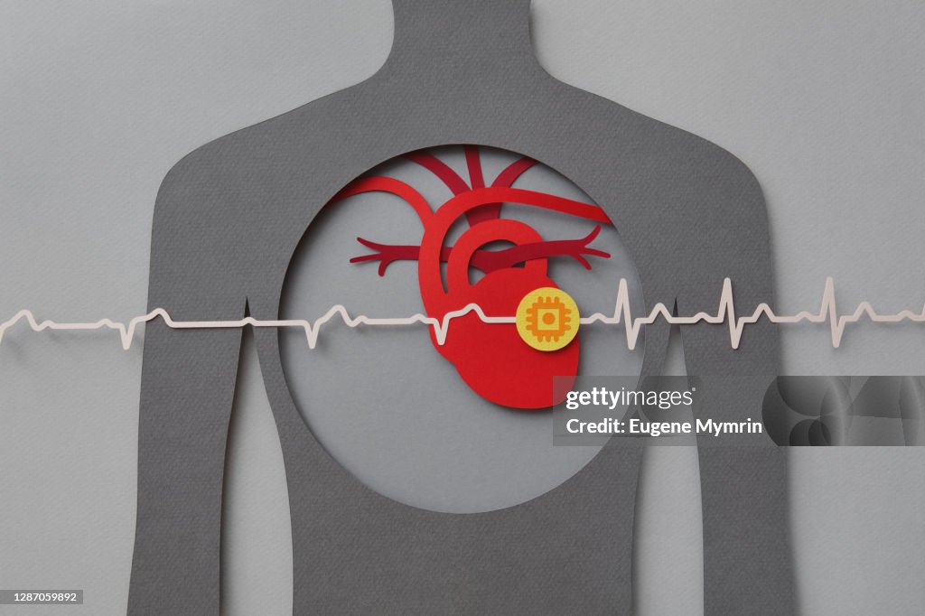 Heart with pacemaker
