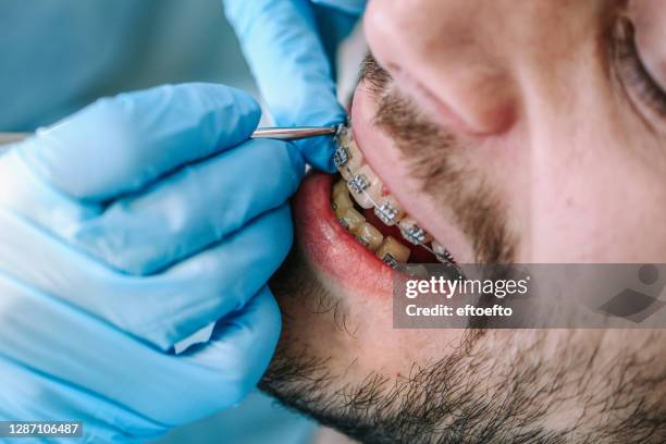 open-mouthed male patient lying in the dental chair while the orthodontist is arranging the braces on teeth - orthodontics stockfoto's en -beelden