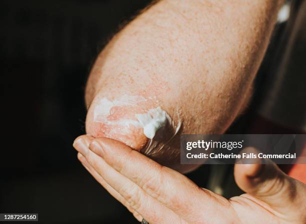 psoriasis on an elbow - body lotion stock-fotos und bilder