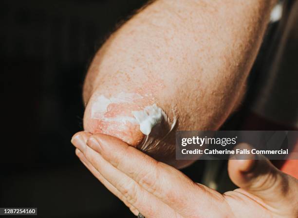 psoriasis on an elbow - psoriasis skin stock pictures, royalty-free photos & images