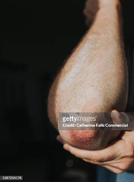 psoriasis on an elbow - psoriasis stock pictures, royalty-free photos & images