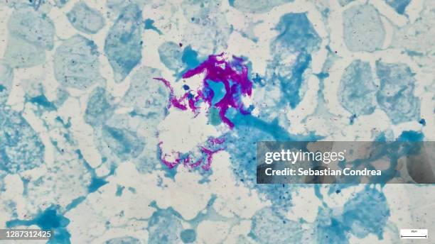 microscopic photo of a professionally prepared slide demonstrating breast tissue with ductal carcinoma. - blood cancer cell stock pictures, royalty-free photos & images