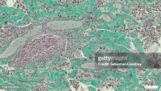 microscopic photo of a professionally prepared slide demonstrating breast tissue with ductal carcinoma. - tejido epitelial fotografías e imágenes de stock