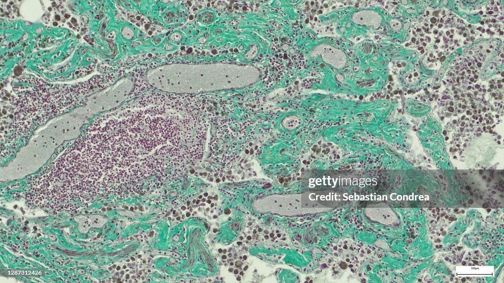 Microscopic photo of a professionally prepared slide demonstrating breast tissue with ductal carcinoma.