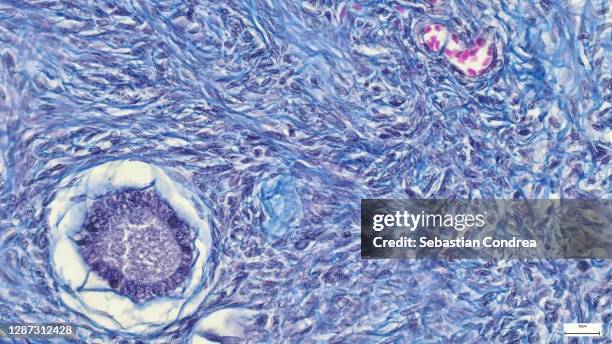 uterine tumour, light micrograph - histologia imagens e fotografias de stock