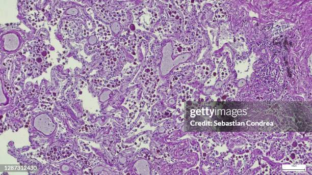 microscopic photo of a professionally prepared slide demonstrating breast tissue with ductal carcinoma. - histologia - fotografias e filmes do acervo