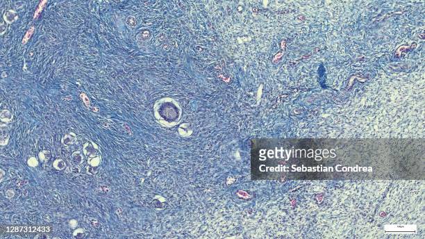 uterine leiomyoma, also known as fibroids,a benign smooth muscle tumor of the uterus, light micrograph, photo under microscope - fibroids stockfoto's en -beelden