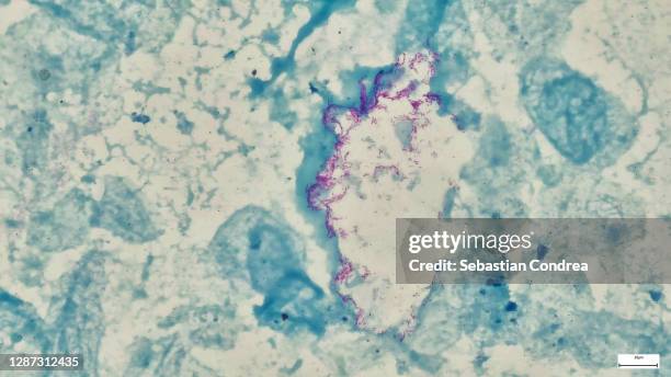 microscopic photo of a professionally prepared slide demonstrating breast tissue with ductal carcinoma. - longweefsel stockfoto's en -beelden