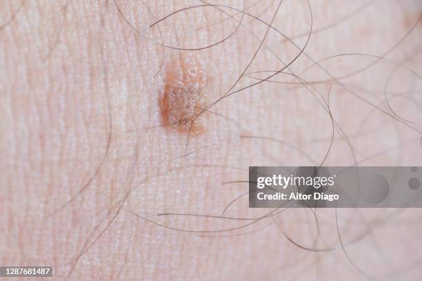 wart in a person's skin. - warts stock pictures, royalty-free photos & images