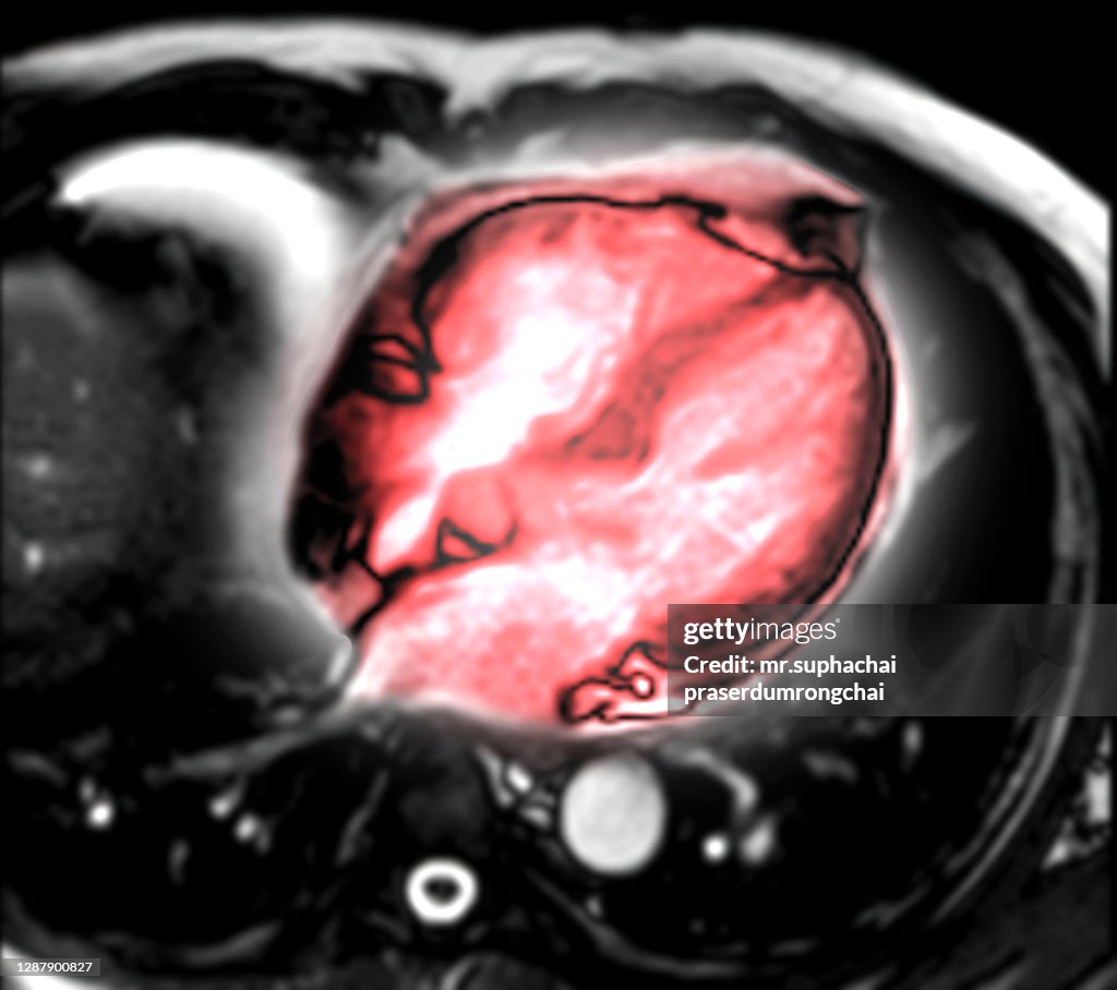 MRI heart or Cardiac MRI .