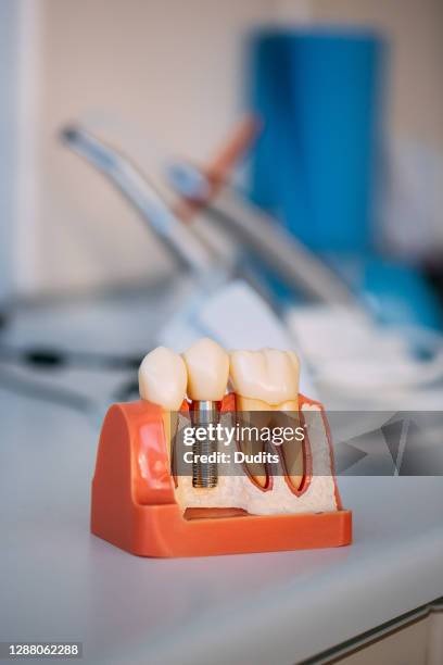 teeth model on dentist's office - implante dentário imagens e fotografias de stock