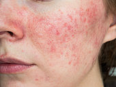 papulopustular rosacea, close-up of the patient's cheek