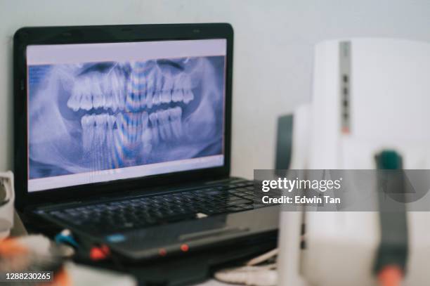 röntgenbildschirm auf laptop in zahnarztpraxis - root canal procedure stock-fotos und bilder