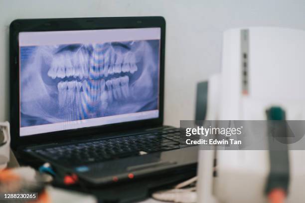 röntgenscherm op laptop bij tandbureau - wortelkanaal stockfoto's en -beelden