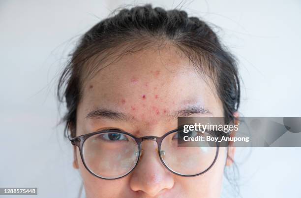 close-up of asian woman with pimple and acne inflamed on her forehead. - cyst stock-fotos und bilder