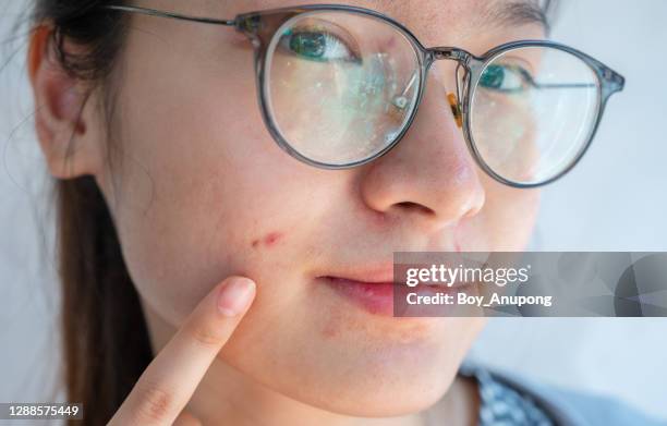 young asian woman pointing problems of acne occur on her face. - dotted human body part stock pictures, royalty-free photos & images