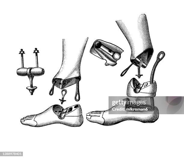 old engraved illustration of artificial leg and foot - prosthetic equipment stock pictures, royalty-free photos & images