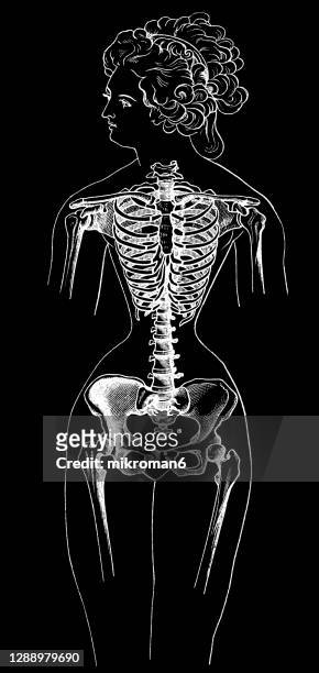 old engraved illustration of a female skeleton deformed by wearing a corset - orthopedic corset stock pictures, royalty-free photos & images