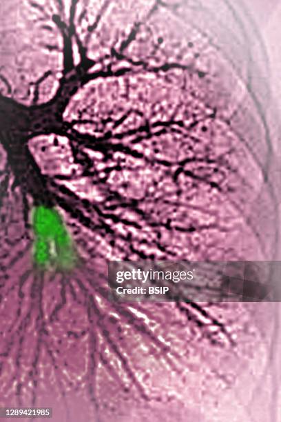 Pulmonary embolism in the left lower lobe . Thoracic angiography.