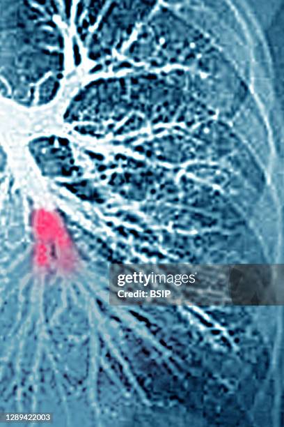 Pulmonary embolism in the left lower lobe . Thoracic angiography.