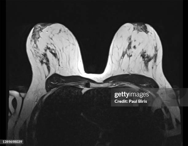 breast magnetic resonance image, or  breast mri - film and television screening stock pictures, royalty-free photos & images