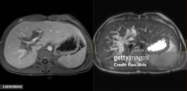mri of plexiform neurofibromas involving the liver in children with neurofibromatosis type 1 - neurofibromatose stock-fotos und bilder