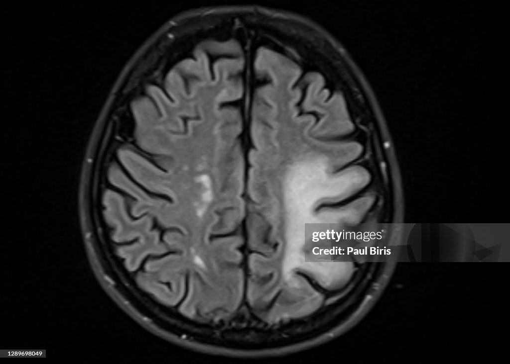 Brain MRI with progressive multifocal leukoencephalopathy (PML)