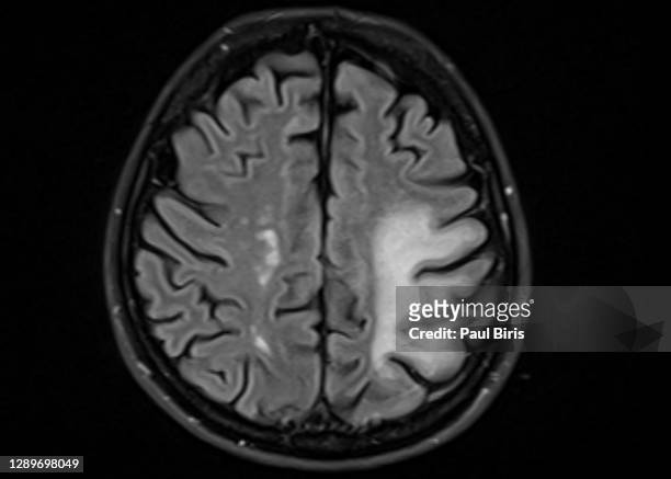 brain mri with progressive multifocal leukoencephalopathy (pml) - cervelet photos et images de collection