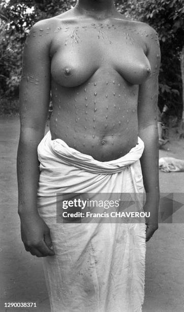 Jeune femme portant des scarifications vaudoues sur la poitrine Bénin.