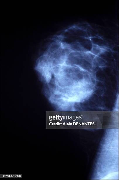 Depistage du cancer du sein chez une femme dans un cabinet de radiologie a Nantes: examen echographique en complement d'une mammographie pour affiner...