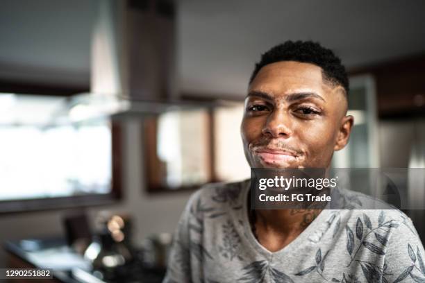 portrait of a young man with vitiligo at home - vitiligo stock pictures, royalty-free photos & images
