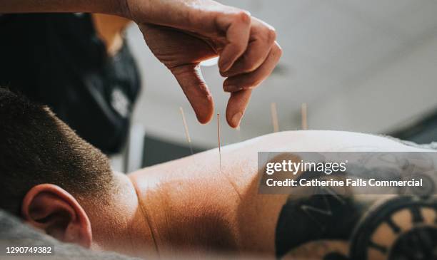 physio performing acupuncture on a patient - agopuntura foto e immagini stock