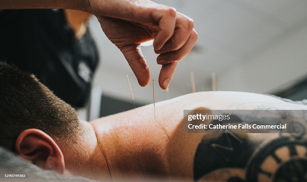 Physio performing acupuncture on a Patient