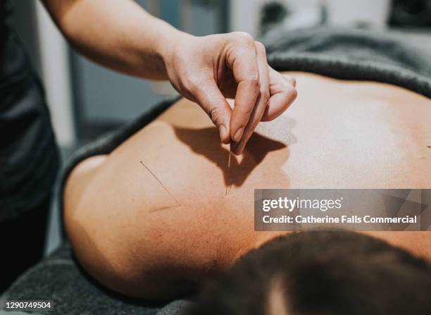 acupuncturist inserts needle - man touching shoulder stock-fotos und bilder