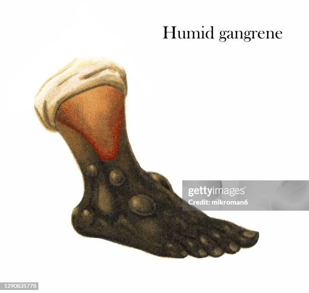 old engraved illustration of skin diseases, humid gangrene - gangrene stock pictures, royalty-free photos & images