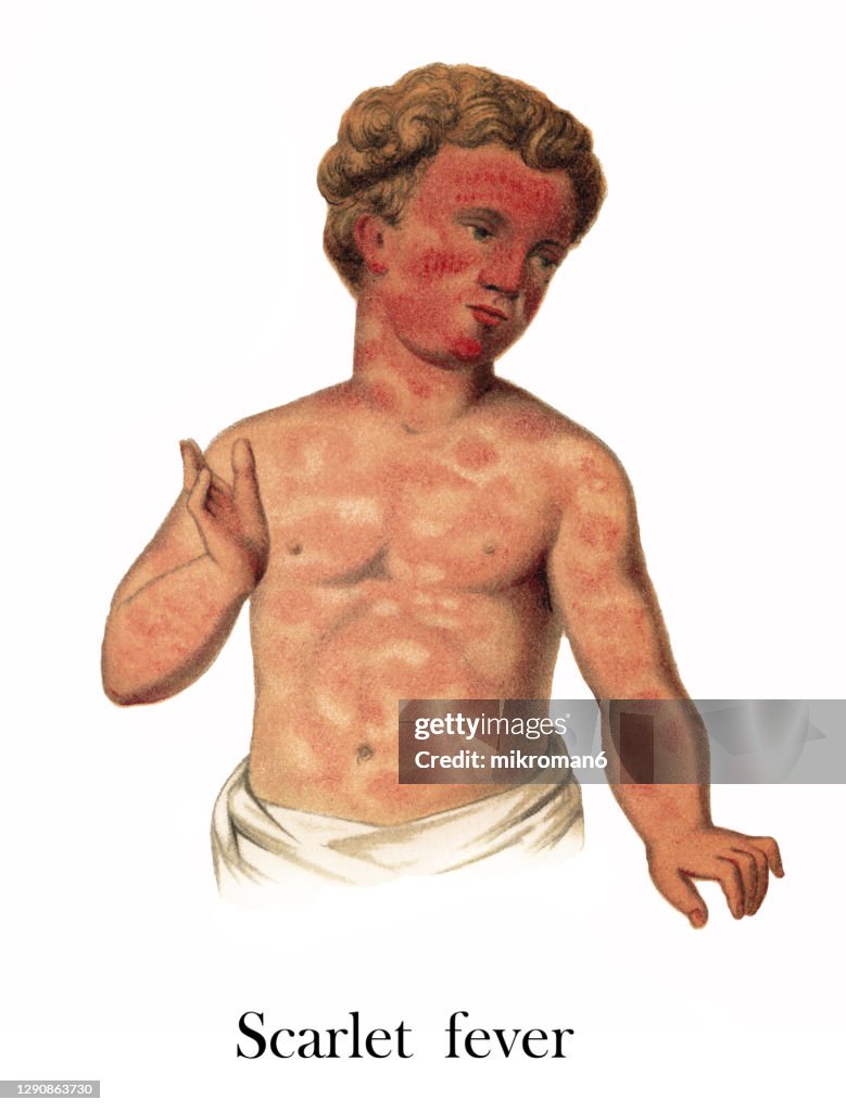 Old engraved illustration of skin diseases, Scarlet fever