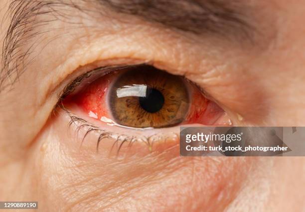 primer plano de un ojo de sangre roja molesto de mujeres adultas maduras afectadas por conjuntivitis o después de la gripe, resfriado o alergia - bloodshot fotografías e imágenes de stock