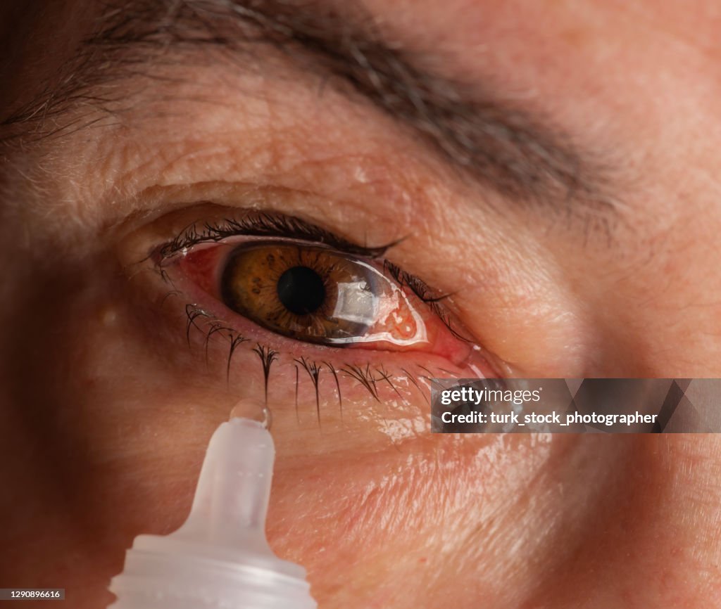 Eye drops are put on the red eyes of the mature woman.