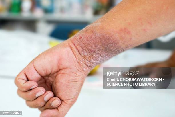 eczema - skin problems stock pictures, royalty-free photos & images