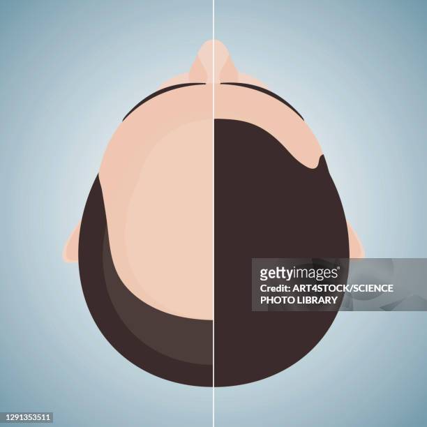 hair loss treatment for men, conceptual illustration - completely bald stock illustrations