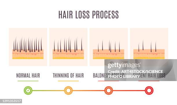 ilustraciones, imágenes clip art, dibujos animados e iconos de stock de hair loss stages, illustration - human scalp