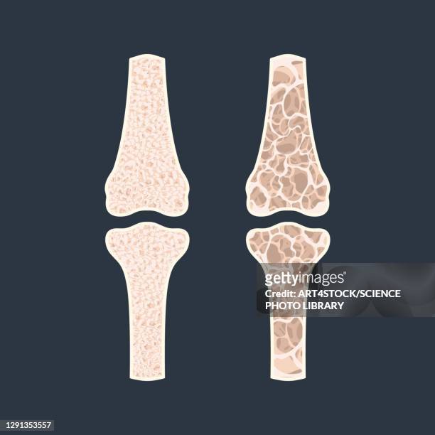 ilustrações, clipart, desenhos animados e ícones de osteoporosis, conceptual illustration - fêmur