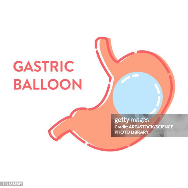 gastric balloon, illustration - 内視鏡点のイラスト素材／クリップアート素材／マンガ素材／アイコン素材