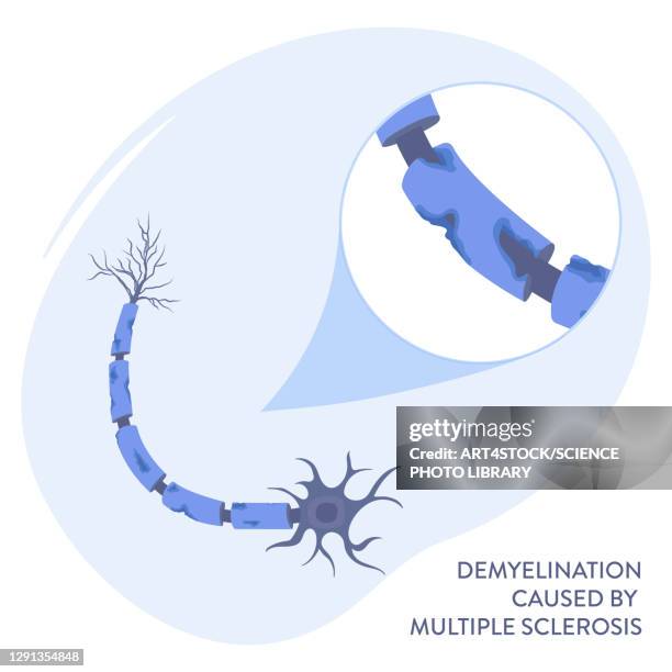 multiple sclerosis, illustration - autoimmune stock illustrations