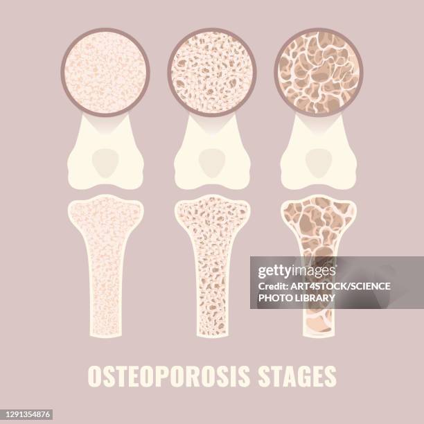 stockillustraties, clipart, cartoons en iconen met osteoporosis stages, illustration - osteoporose