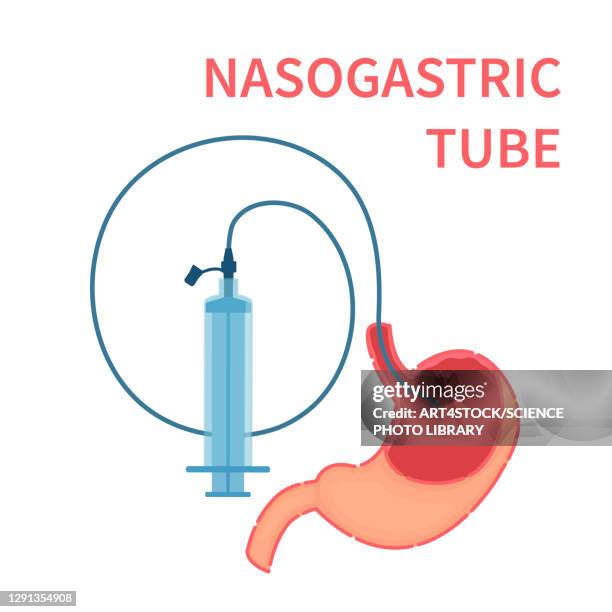 nasogastric feeding tube, illustration - intubation stock illustrations