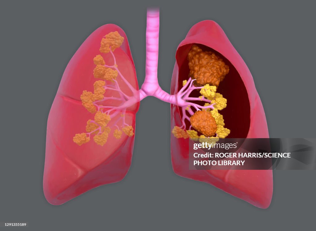 Lung cancer, illustration