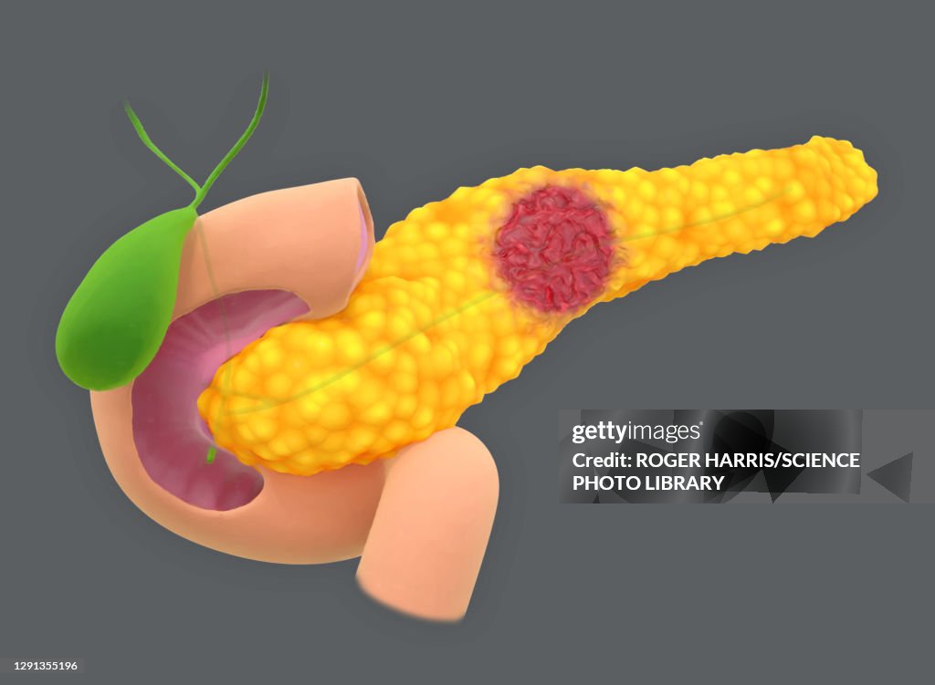Pancreatic neuroendocrine tumour, illustration